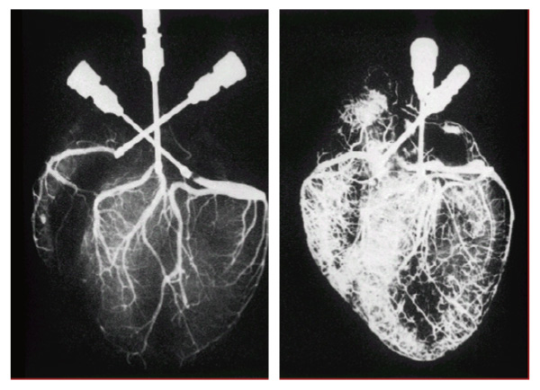 (左圖) 治療前，血管堵塞嚴重，心臟嚴重缺氧 | (右圖) 治療後，重生新生血管，心臟回復元氣