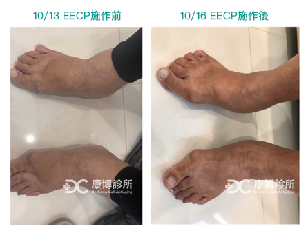 康博診所 EECP 體外反搏療程 案例分享 腳部水腫
